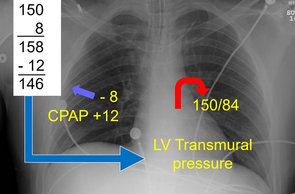 The Miracle of CPAP